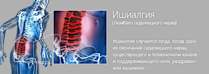 Ішіас &ndash; запалення сідничного нерва: причини, симптоми і лікування в домашніх умовах медикаментозне і народними засобами. Вправи при ішіасі, розтяжка, йога, фізіотерапія, голковколювання, точковий масаж, укуси бджіл: опис, відео