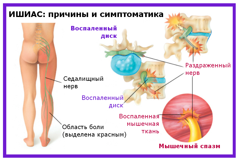 Ішіас &ndash; запалення сідничного нерва: причини, симптоми і лікування в домашніх умовах медикаментозне і народними засобами. Вправи при ішіасі, розтяжка, йога, фізіотерапія, голковколювання, точковий масаж, укуси бджіл: опис, відео
