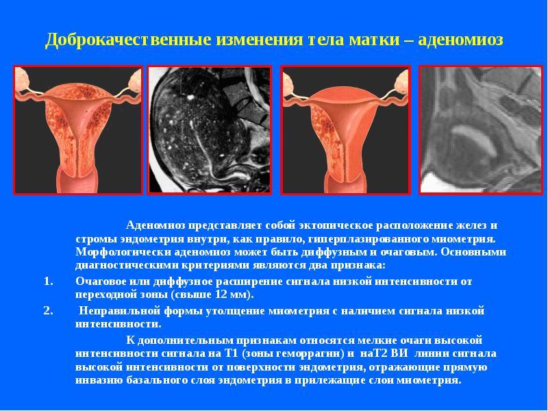 Ендометрит та ендометріоз, аденоміоз: у чому різниця і подібності?