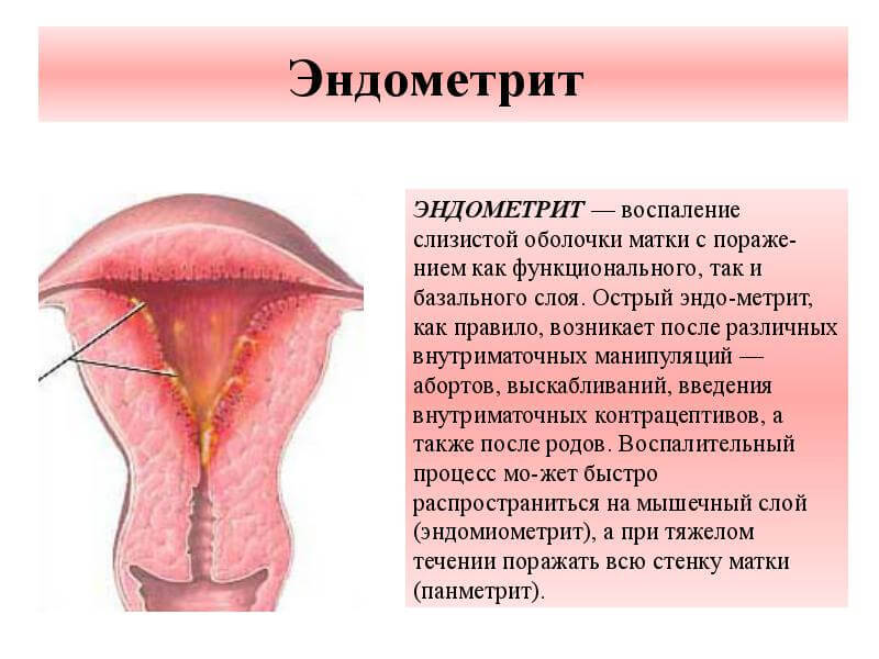 Ендометрит та ендометріоз, аденоміоз: у чому різниця і подібності?