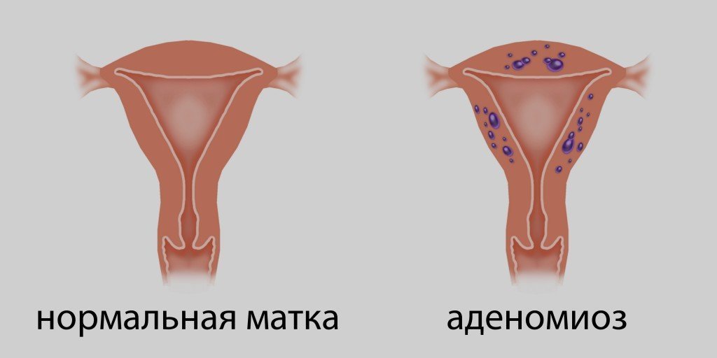 Ендометрит та ендометріоз, аденоміоз: у чому різниця і подібності?