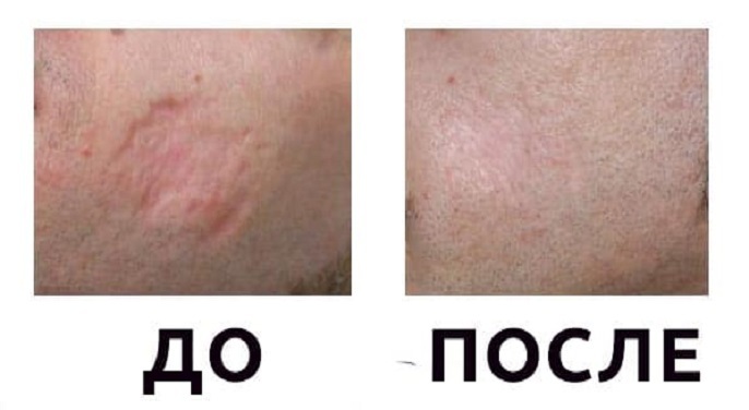 Як позбутися від шрамів після вітрянки, операції, опіку? Як позбутися від шрамів в домашніх умовах? Мазі для лікування рубців і шрамів