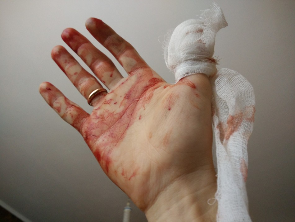 Як і чому зупинити кров з пальця при порізі і глибокому порізі, якщо вона пульсує і не зупиняється: варіанти першої допомоги, препарати для зупинки крові. В яких випадках при порізі звертатися до лікаря?
