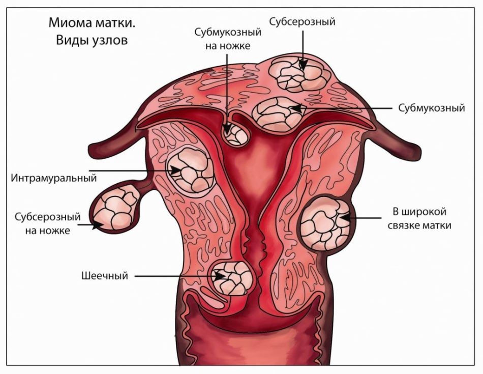 Міома матки під час вагітності: чи небезпечна, чим загрожує, які наслідки для дитини? Можуть міому матки переплутати з вагітністю? Може міома матки кровить, хворіти або розсмоктатися при вагітності?