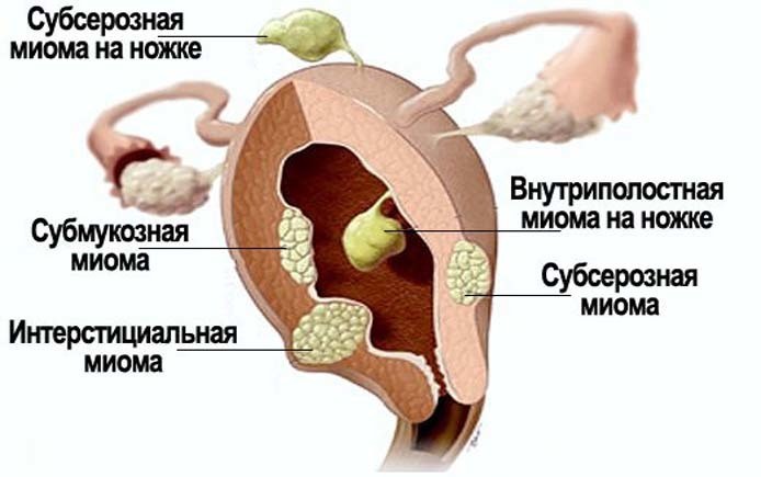 Міома матки під час вагітності: чи небезпечна, чим загрожує, які наслідки для дитини? Можуть міому матки переплутати з вагітністю? Може міома матки кровить, хворіти або розсмоктатися при вагітності?