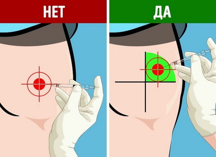 Укол, ін'єкція внутрішньом'язово в ногу, стегно самому собі: інструкція. Куди можна колоти уколи внутрішньом'язово самому? Коли не можна робити уколи самостійно?