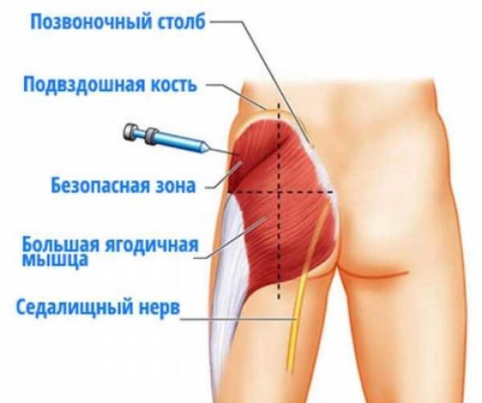 Укол, ін'єкція внутрішньом'язово в ногу, стегно самому собі: інструкція. Куди можна колоти уколи внутрішньом'язово самому? Коли не можна робити уколи самостійно?