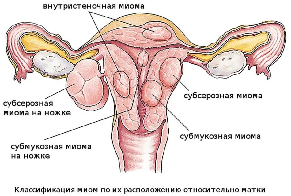 Міома матки під час вагітності: чи небезпечна, чим загрожує, які наслідки для дитини? Можуть міому матки переплутати з вагітністю? Може міома матки кровить, хворіти або розсмоктатися при вагітності?