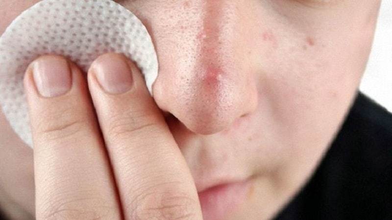 Що таке демодекоз і демодекс у людини: опис, фото. Хвороба у людини демодекоз: шляхи зараження, причини прищів, початкові ознаки, симптоми, діагностика, аналіз, лікування шкіри в домашніх умовах медикаментозне і народними засобами, профілакти