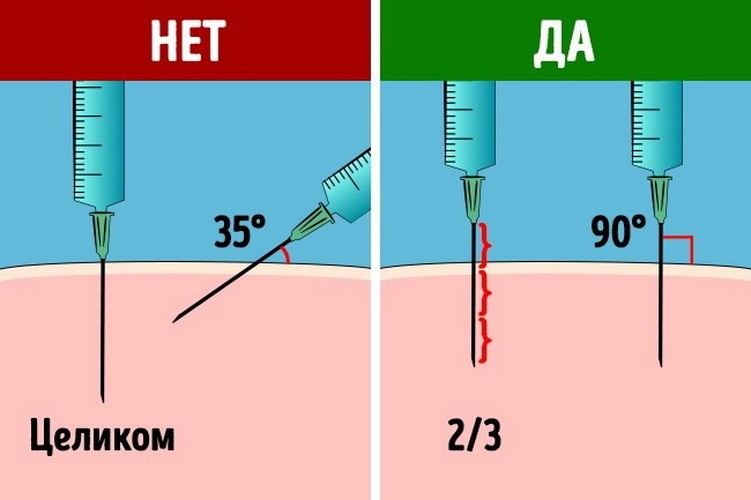 Укол, ін'єкція внутрішньом'язово в ногу, стегно самому собі: інструкція. Куди можна колоти уколи внутрішньом'язово самому? Коли не можна робити уколи самостійно?