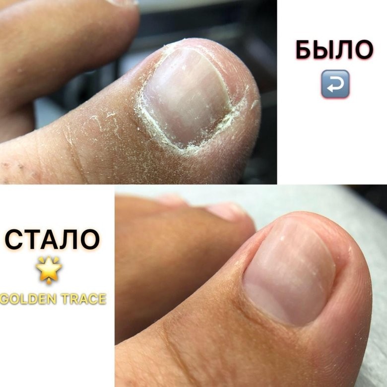 Голден Трейс педикюр