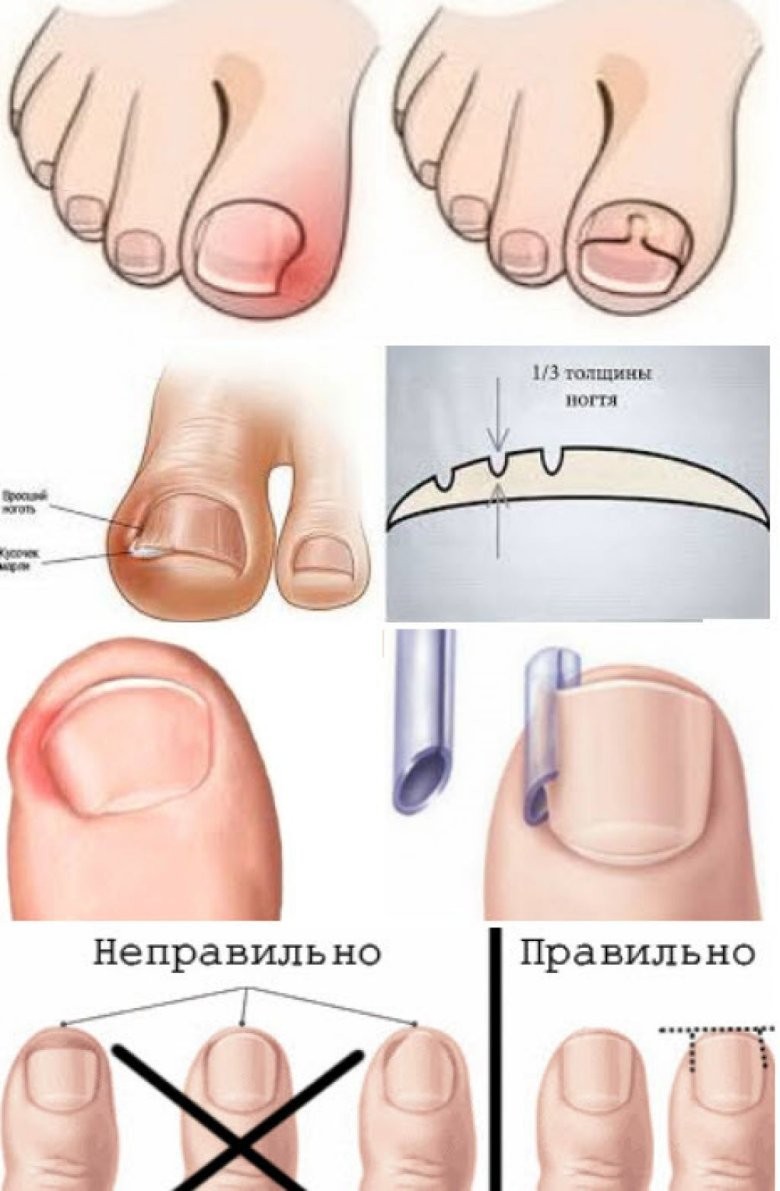 Воспаленный вросший ноготь