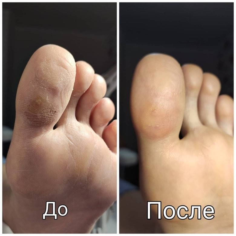 Препаратный педикюр до и после