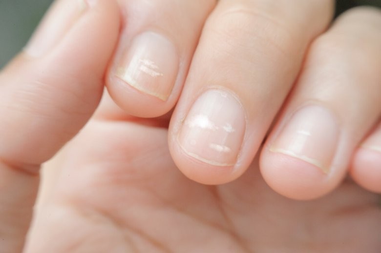 Микотическая лейконихия