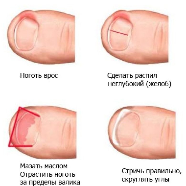 Врошийся ноготь на ноге