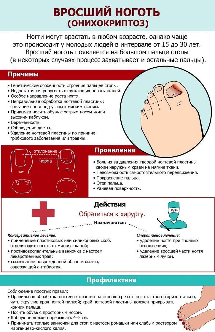 Вросший ноготь на большом пальце