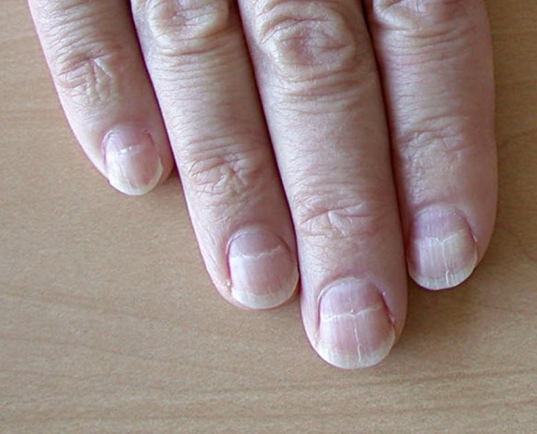 Лейконихия (белые пятнышки)