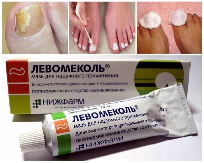Китайский набор от грибка ногтей Nail fungus