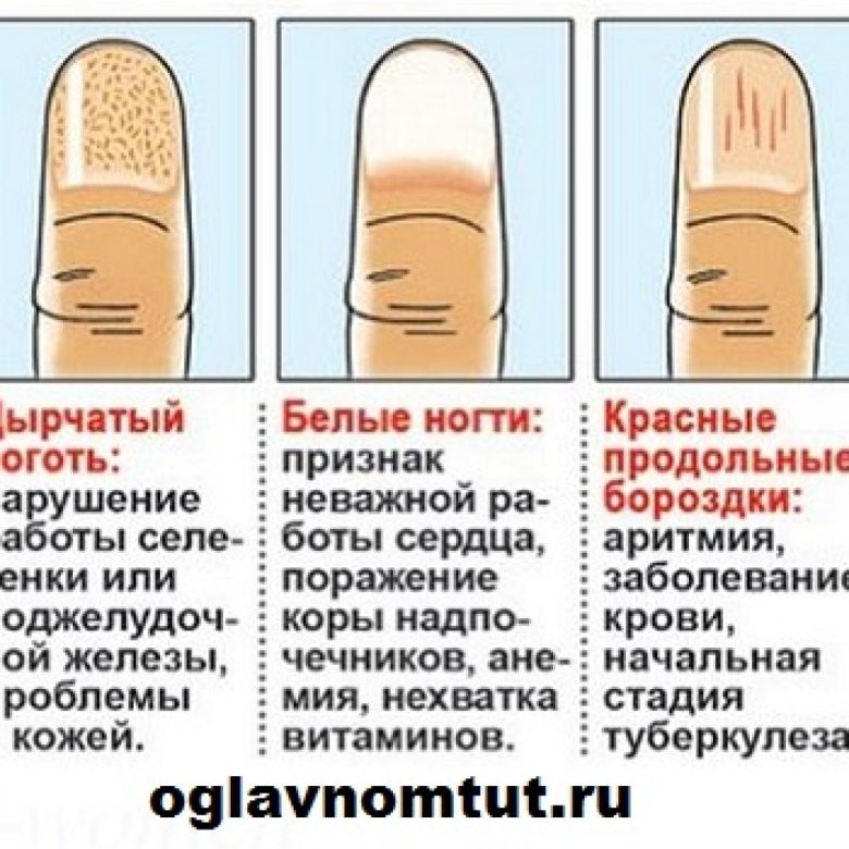 Белые точки на ногтях причина (59 фото)
