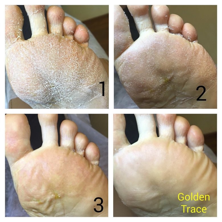 Педикюр с использованием препаратов Golden Trace