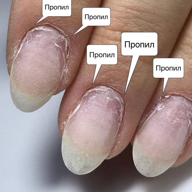 Продольные бороздки на ногтях