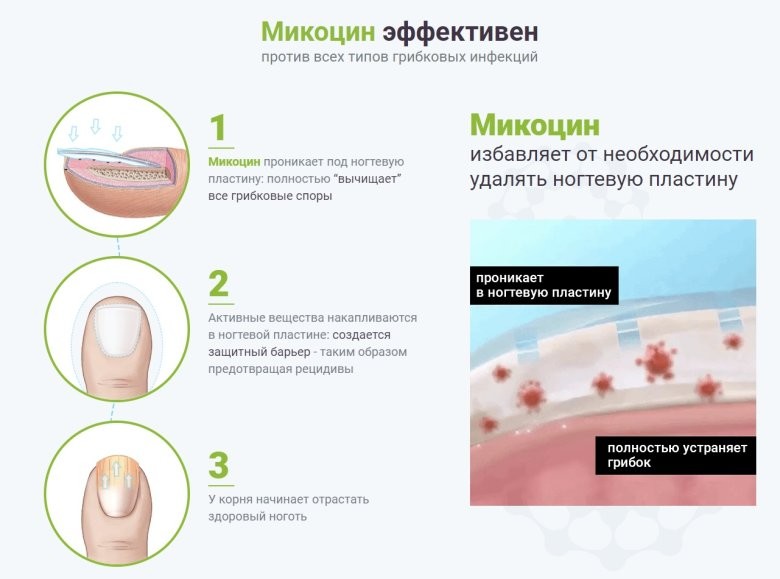 Грибок ногтей лекарство