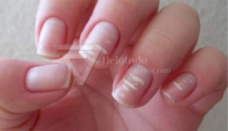 Микотическая лейконихия