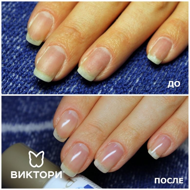 Лечебное ламинирование ногтей