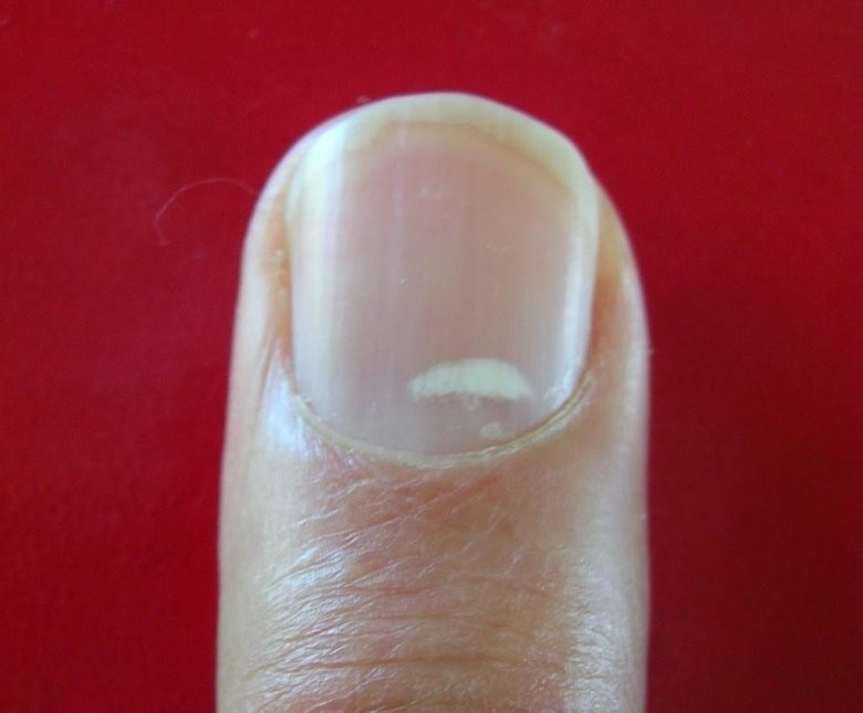Микотическая лейконихия