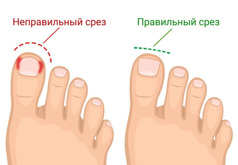 Как правильно подстригать ногти на ногах
